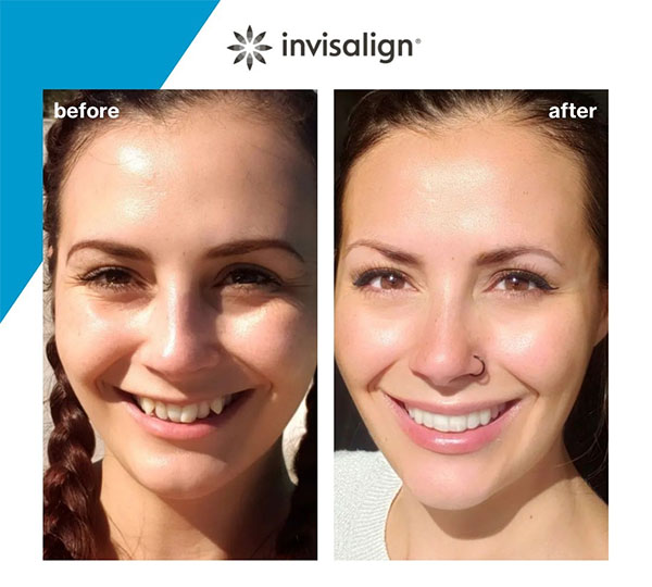 Ennen ja jälkeen Invisalign kalvo-oikomisen